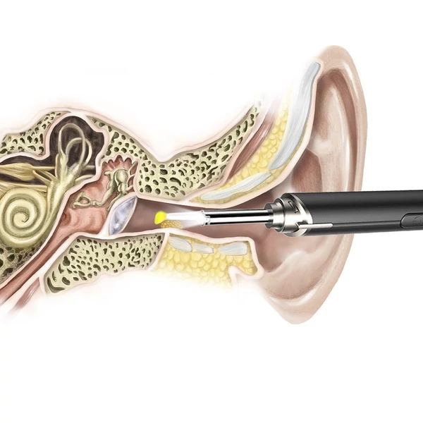 Intelligens kamerás vizuális fül otoszkóp LED-del, vezetéknélkül - Fehér